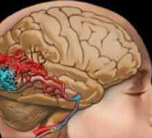 Malformacije cerebralnih krvnih žila