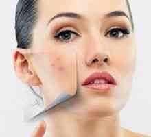 6 Načina da biste dobili osloboditi od acne kod kuće brz: recepti