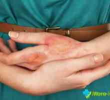 Masti iz dermatitis na rukama: najviše pristupačne i učinkovit