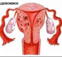Menstruacija s adenomioze