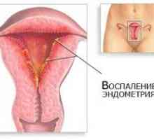 1 Mjesec na endometrioza