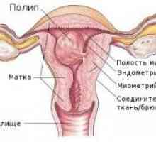 Menstruacija u polipa 18