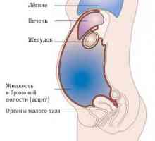 Uzroci i liječenje trbušne hidropsiju