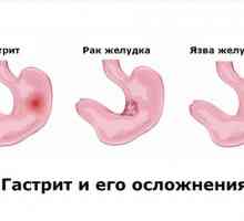 Metode liječenja gastritisa hipertrofične