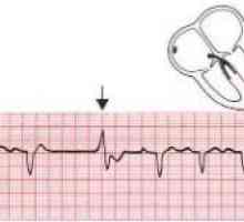 Metode liječenja aritmija srca
