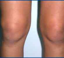 Metode liječenja sinovitis koljena. Simptomi ove bolesti.
