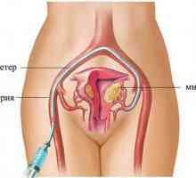 Uterine fibroids (fibroidi) bez operacije zapravo liječi
