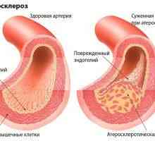 Folk lijekovi za arteriosklerozu donjih ekstremiteta