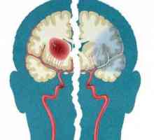 Arterijska cirkulacija od poremećaja mozga: oblici, simptoma, liječenje