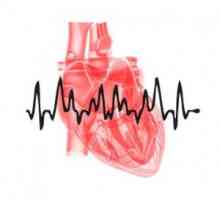 Srčane aritmije: vrste, uzroci, simptomi, liječenje