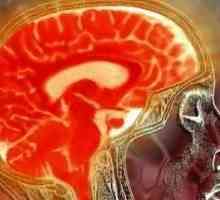 Vanjski zamjena hidrocefalus mozak