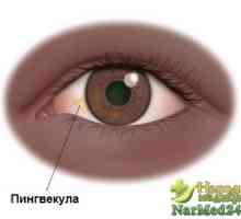 Kako opasno pinguecula oči i tajna narodne medetsiny u liječenju