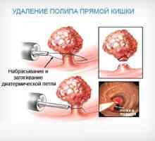 Recepti liječenje polipa u crijevima narodnih lijekova
