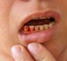 Što je krvarenje zubnog mesa