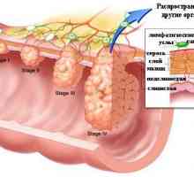 O uzrocima raka debelog crijeva
