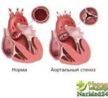 Olakšavanja simptoma stenozom aorte u odraslih i djece