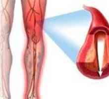 Ateroskleroze donjih ekstremiteta (noge)