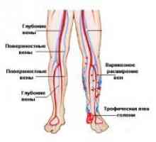 Ateroskleroze donjih udova: postupci liječenja bolesti