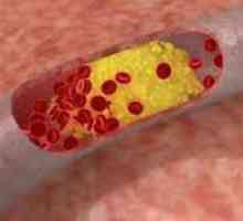 Pregled lijekova koji smanjuju kolesterol u krvi