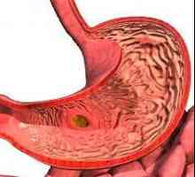Focal gastritis - lezija želučane sluznice površina