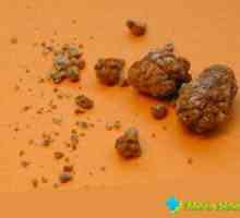 Oksalat bubrežnih kamenaca: simptomi i uzroci, liječenju, prevenciji
