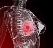 Oleogranulema - upalne tumor dojke