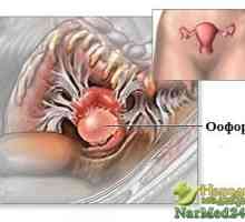 Oophoritis - ozbiljna prijetnja zdravlju ženskog
