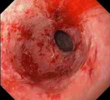Opasan oblik bolesti - hemoragijski gastritis