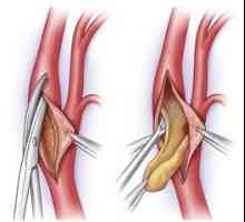 Kirurgija za uklanjanje kolesterola plakova kod ateroskleroze (endarterektomija karotide)