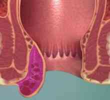 Komplikacije hemoroida - venska tromboza i upala vena: znakovi, tretmani, utjecaj