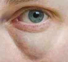 Glavni uzroci otekline ispod očiju