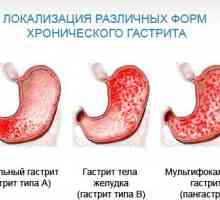 Obilježja antralnog gastritisa i postupci liječenja
