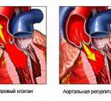 Značajke aorte insuficijencije i sa stupnjem