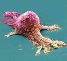 Dijagnostici i liječenju raka dojke Paget