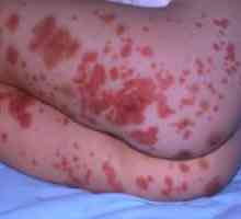 Značajke hemoragične vaskulitisa u djece