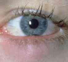 Značajke liječenje čireva na oku