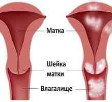 Značajke menstruacija rak maternice i jajnika