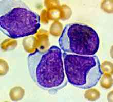 Deset najvećih znakovi leukemije krvi