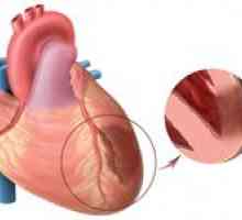 Značajke infarkta miokarda i njegovo liječenje