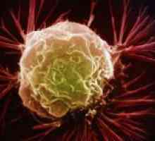 Značajke leukemiju vlasastih limfocita