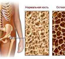 Osteoporoza - glavni uzrok prijeloma