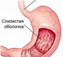 Akutne i kronične gastritis