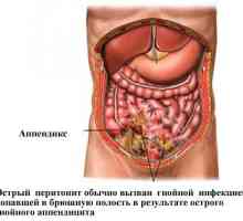 Značajke protoka ozbiljnim peritonitis