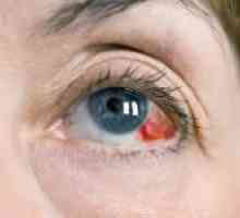 Zašto praska krvne žile u očima: glavne razloge