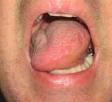Oticanje usta, jezika i grla