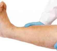 Oticanje noge muškaraca: uzroci, liječenje i prevencija