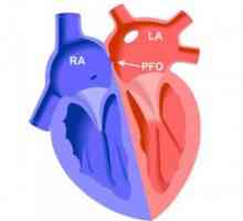 Foramen ovale (rupa) u srcu, uzrokuje zatvaranje prognoza