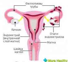 Endometrioza 1 stupanj