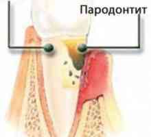 Parodontitis - uzroci i rješenja za probleme
