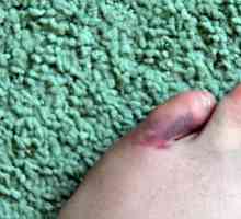 Fraktura malog prsta na nozi: Simptomi i liječenje
